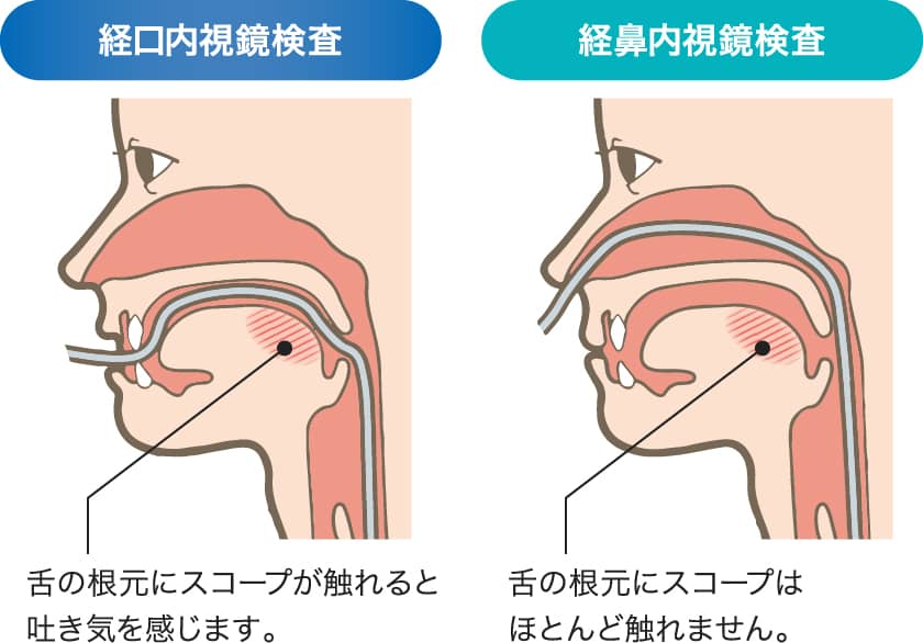 経口内視鏡、経鼻内視鏡のどちらかを選んでいただけます